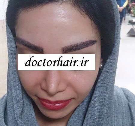 مشاوره کاشت مو وابرو 