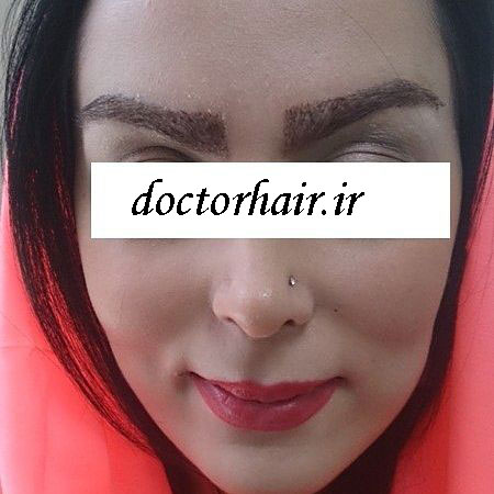 مشاوره کاشت مو وابرو 